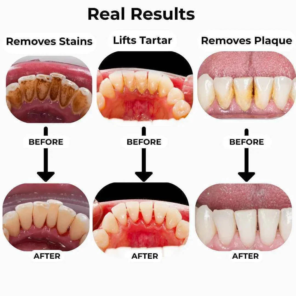 T8 Ultrasonic Tooth Cleaner - Professional Dental Plaque Remover for a Healthier Smile